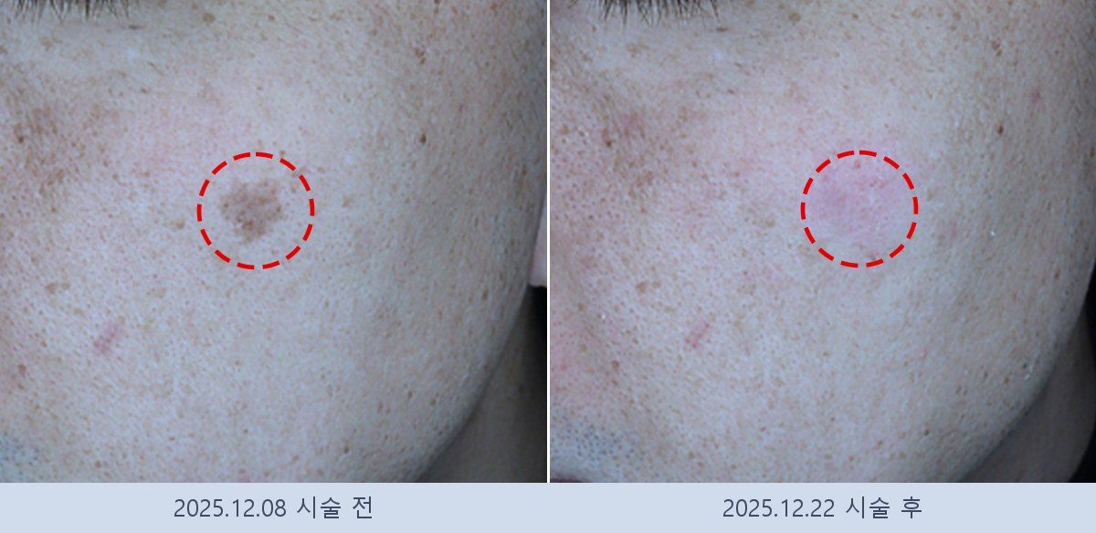 흑자 검버섯