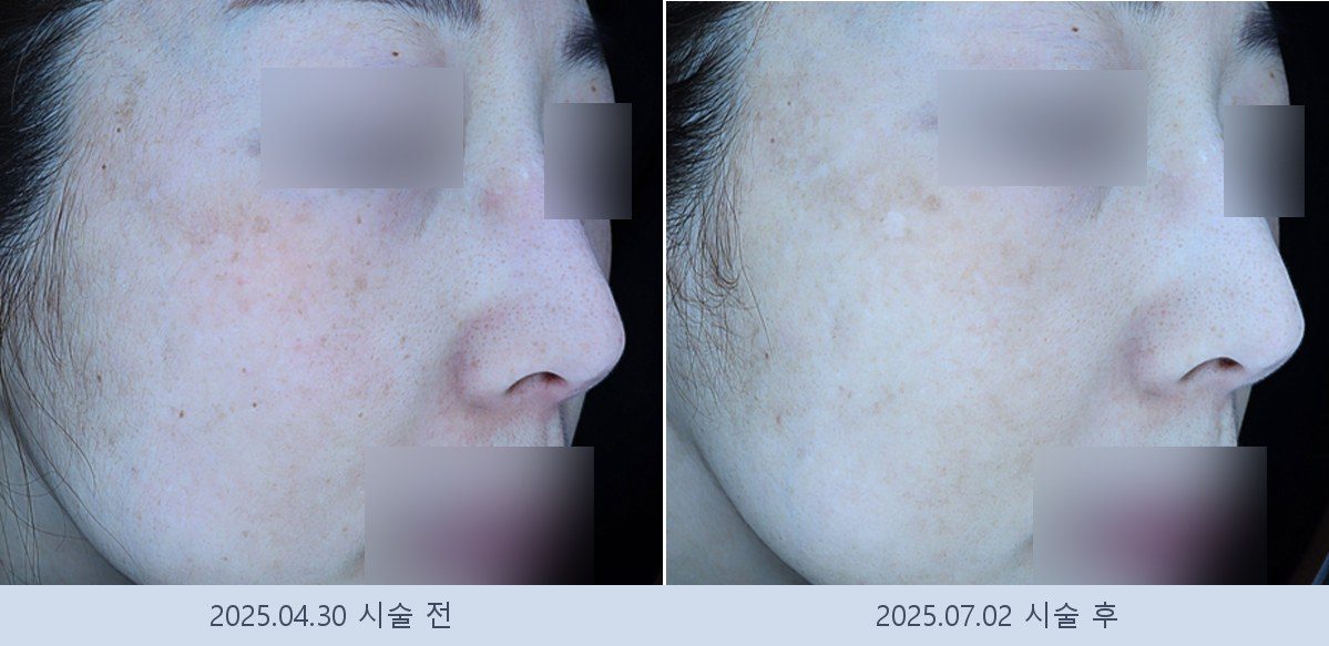 기미 잡티